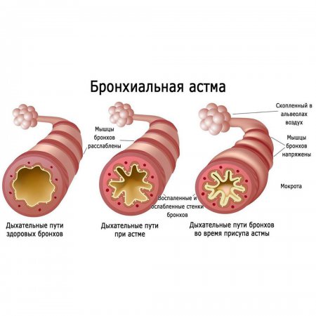 Остеопатия в лечении бронхиальной астмы