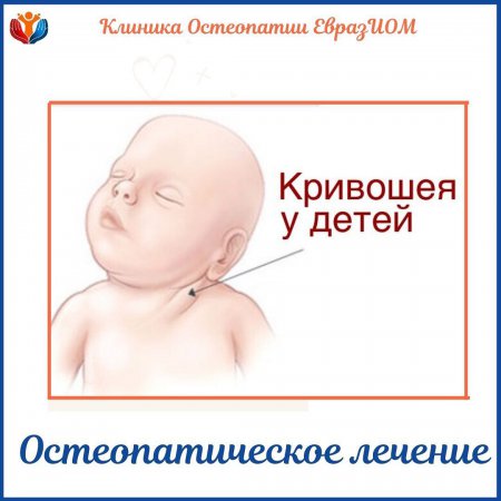 Остеопатическое лечение при кривошеи у младенцев