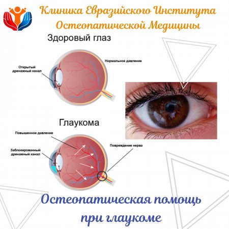 Остеопатическая помощь при глаукоме